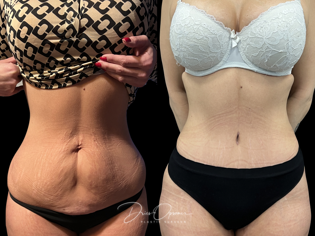 buikwandcorectie-dries-opsomer-6