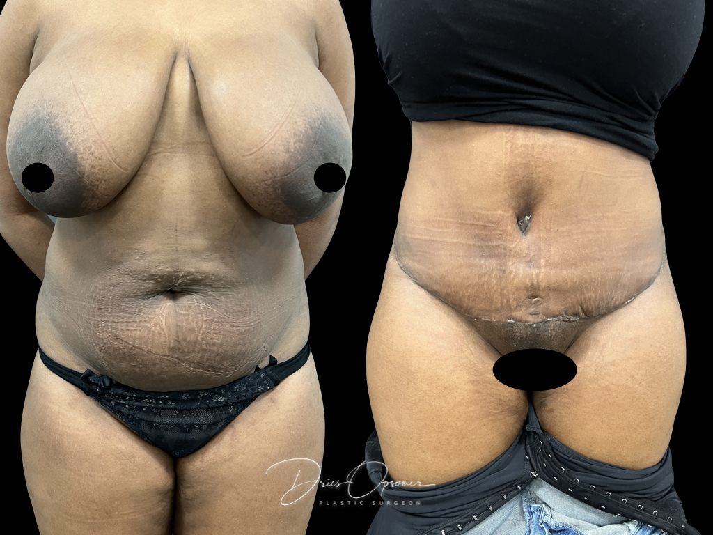 buikwandcorectie-dries-opsomer-7