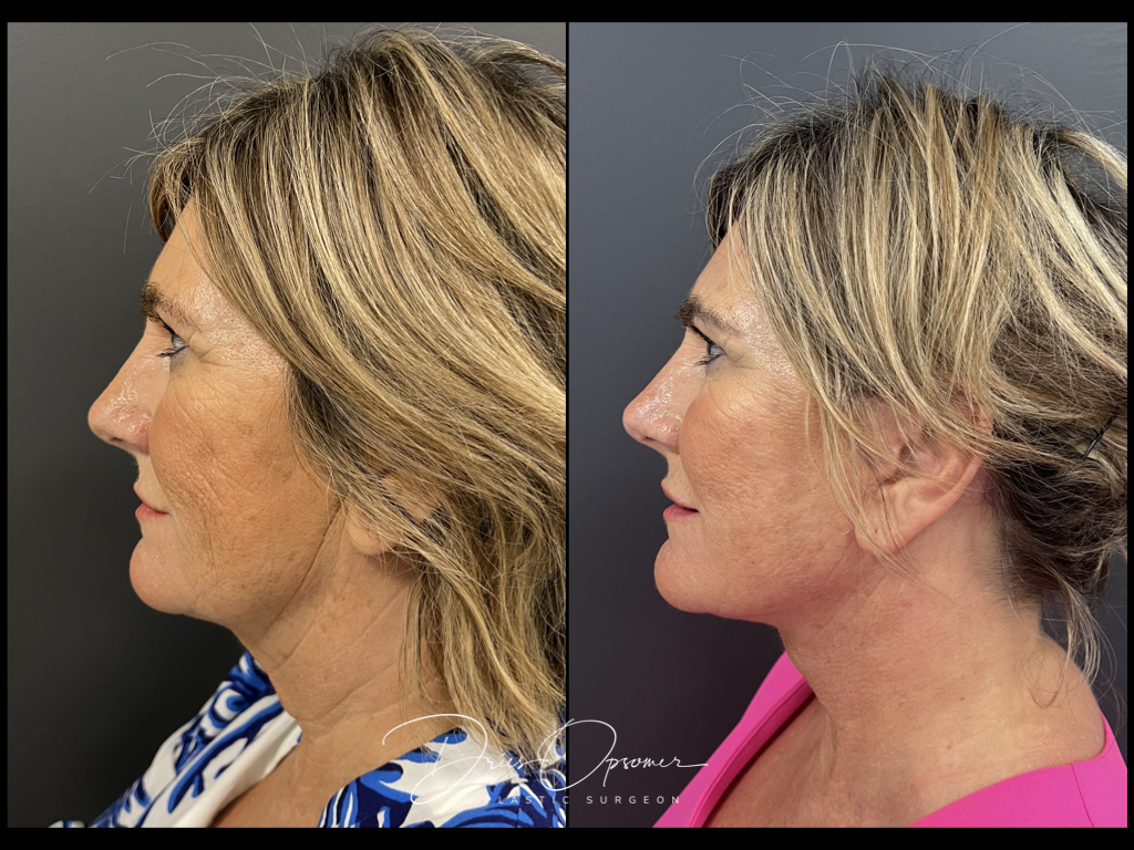 facelift-dries-opsomer-18