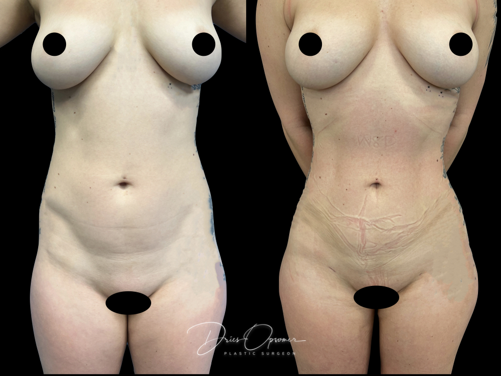 high-def-lipo-dries-opsomer-06