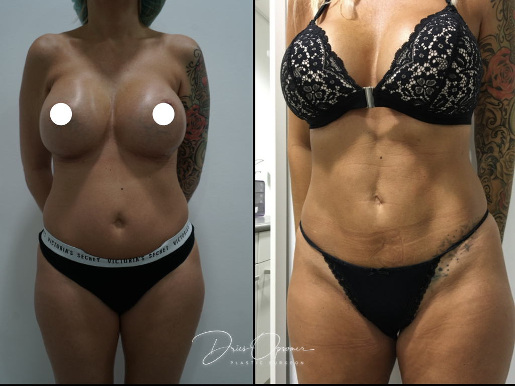 high-def-lipo-dries-opsomer-08