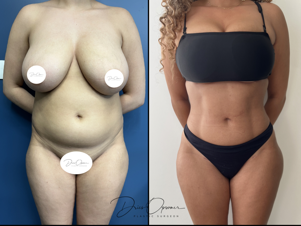 high-def-lipo-dries-opsomer-11