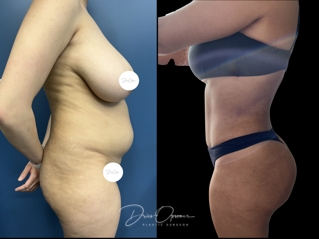 high-def-lipo-dries-opsomer-13