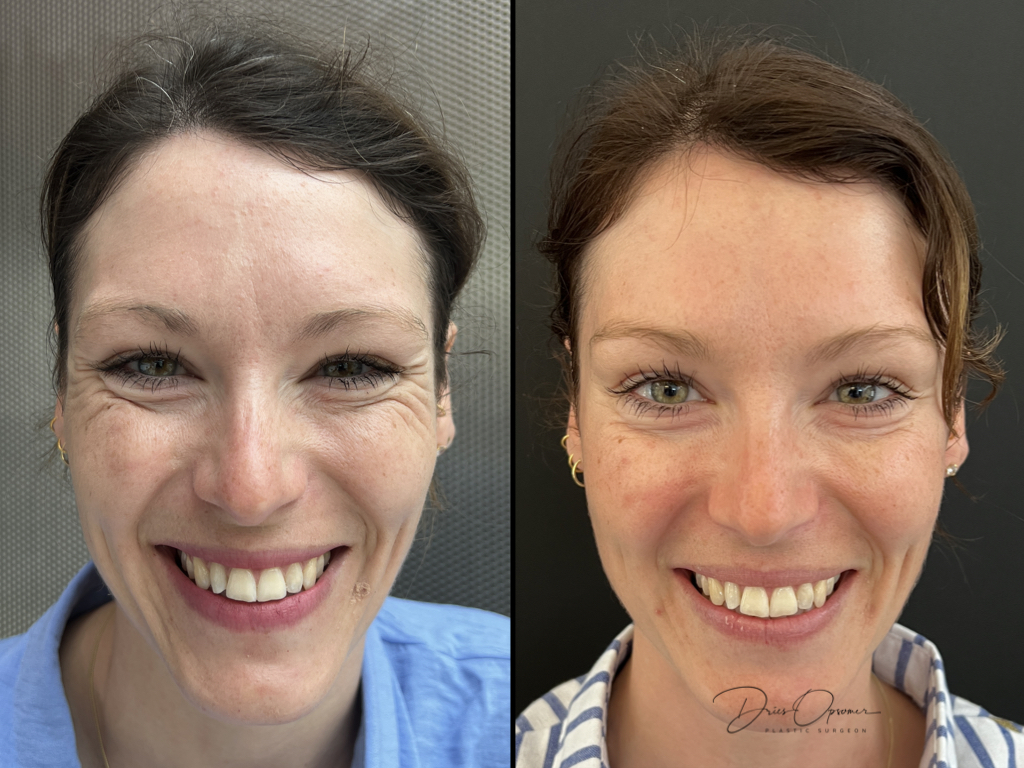 injectables-dries-opsomer-1