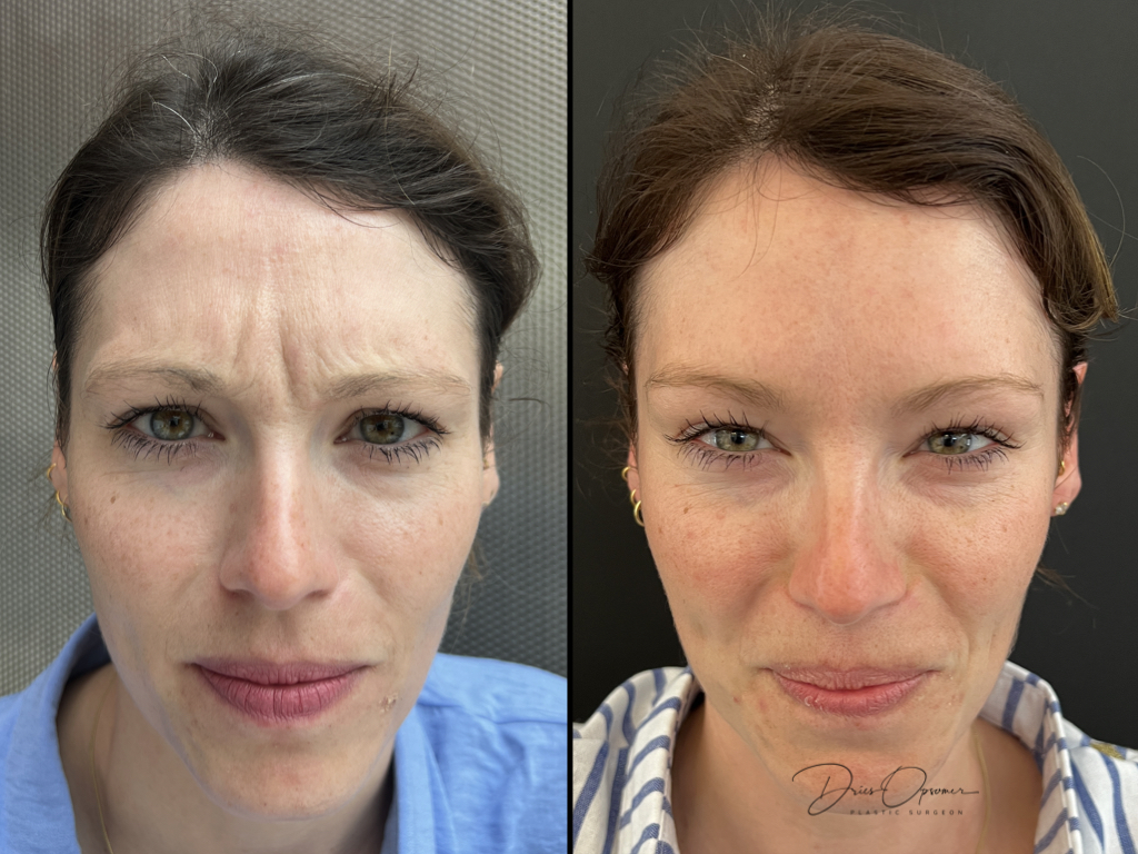 injectables-dries-opsomer-2