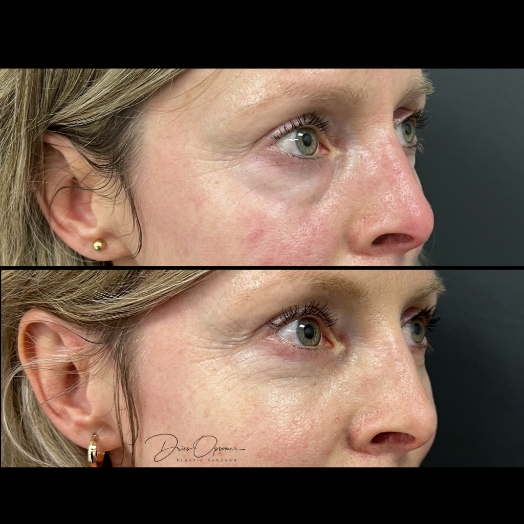 ooglidcorrectie-dries-opsomer-10