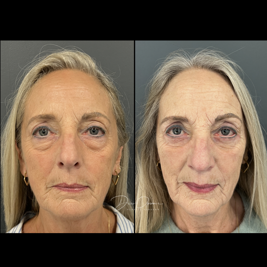 ooglidcorrectie-dries-opsomer-15