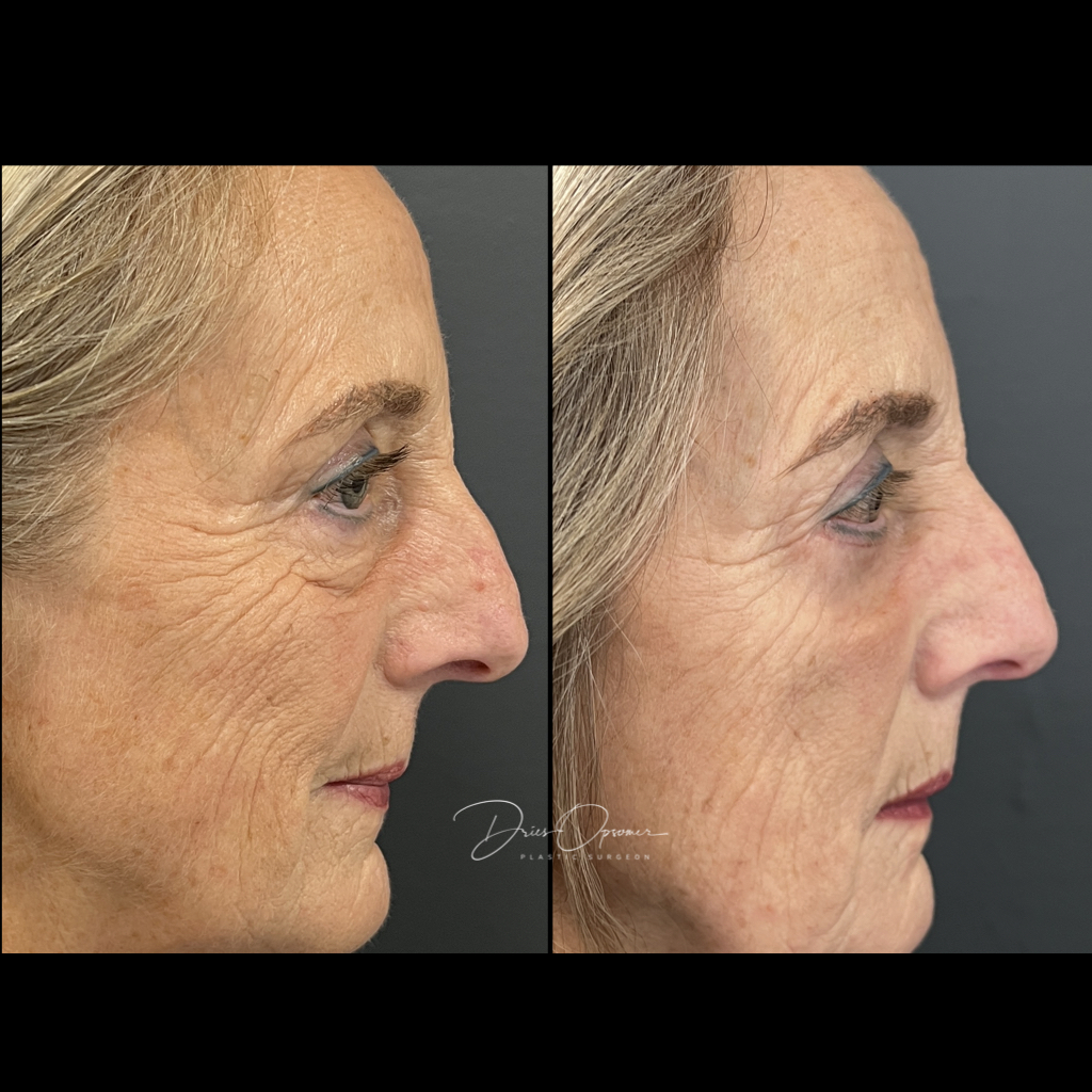 ooglidcorrectie-dries-opsomer-18