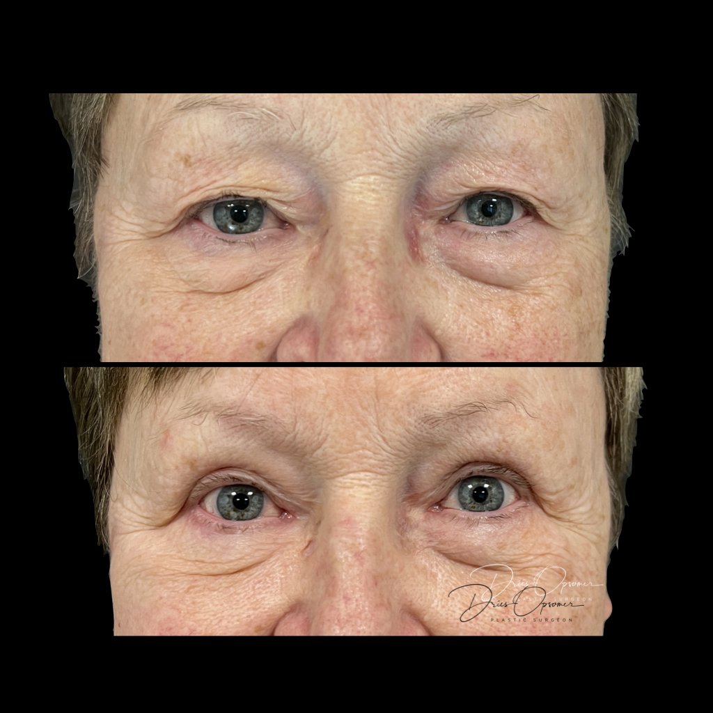 ooglidcorrectie-dries-opsomer-7