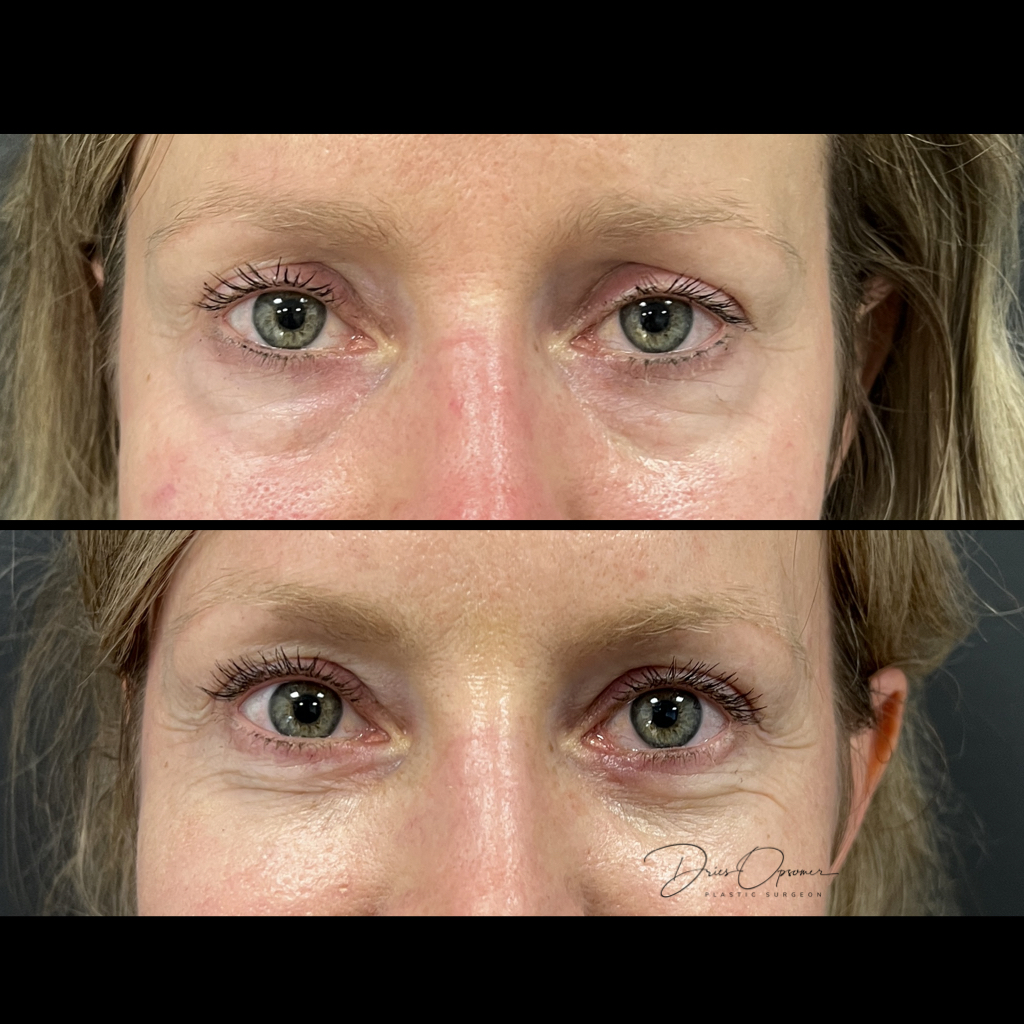 ooglidcorrectie-dries-opsomer-9