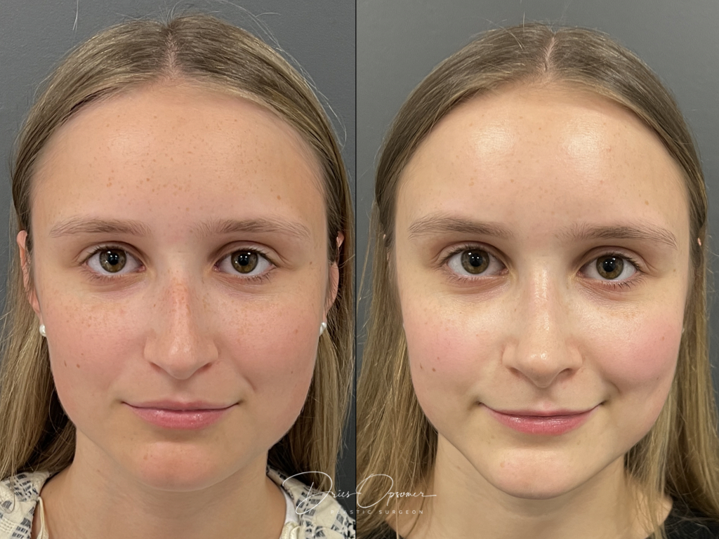 rhinoplastie-dries-opsomer-1