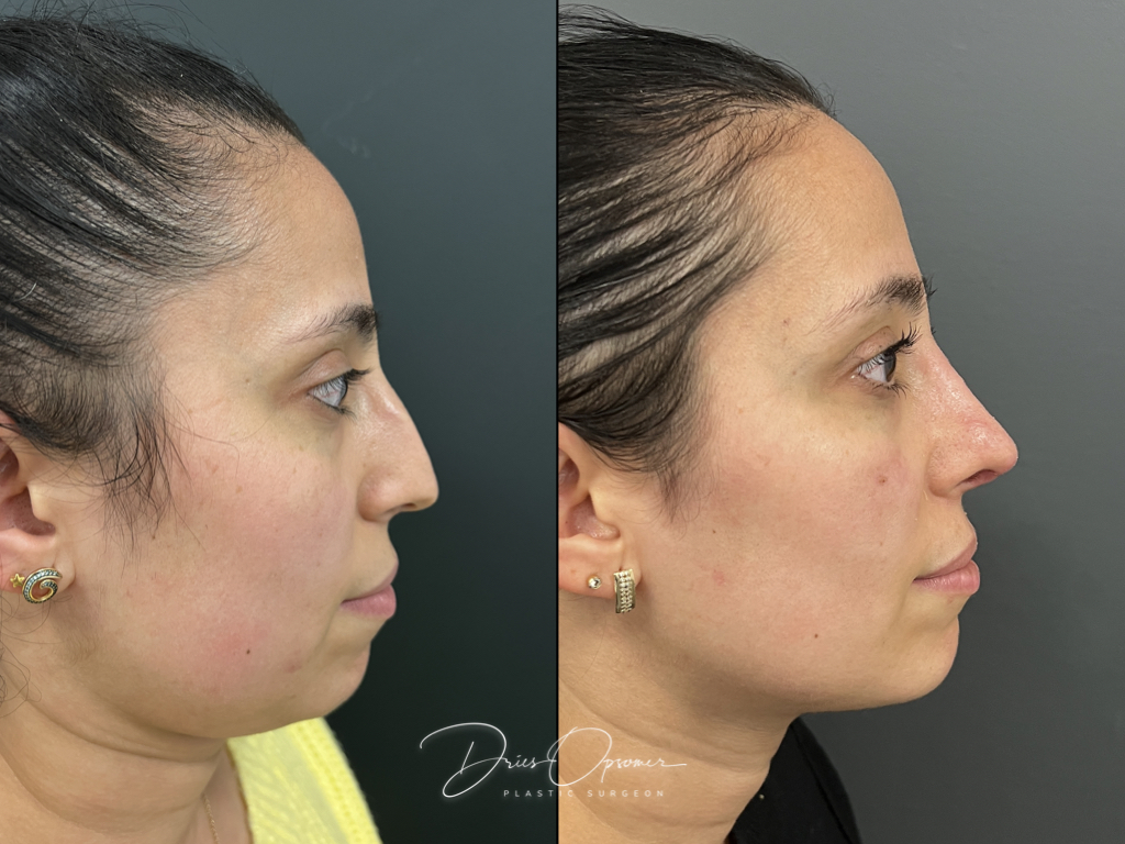 rhinoplastie-dries-opsomer-10