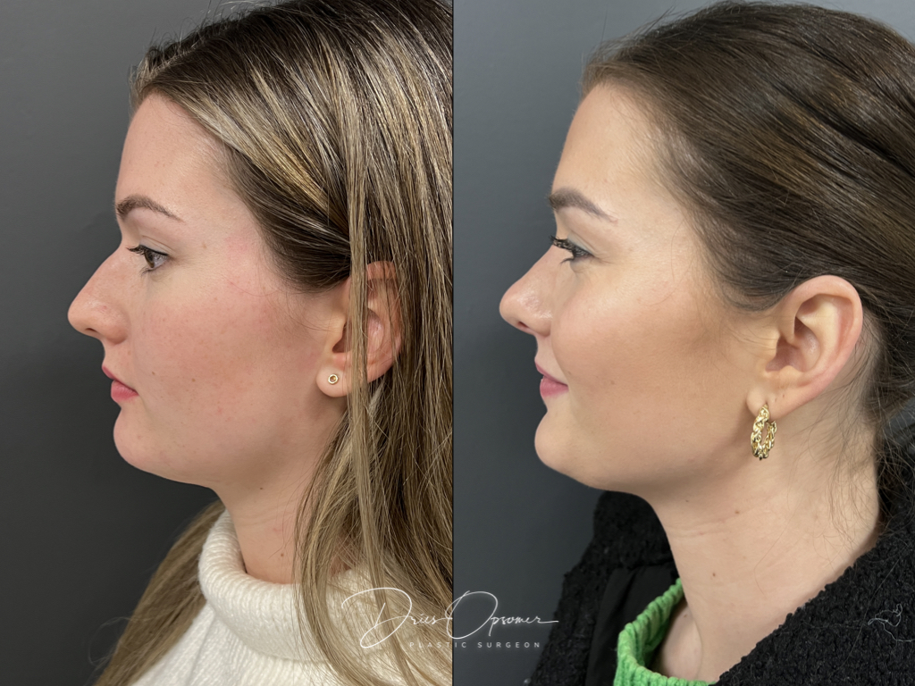 rhinoplastie-dries-opsomer-12