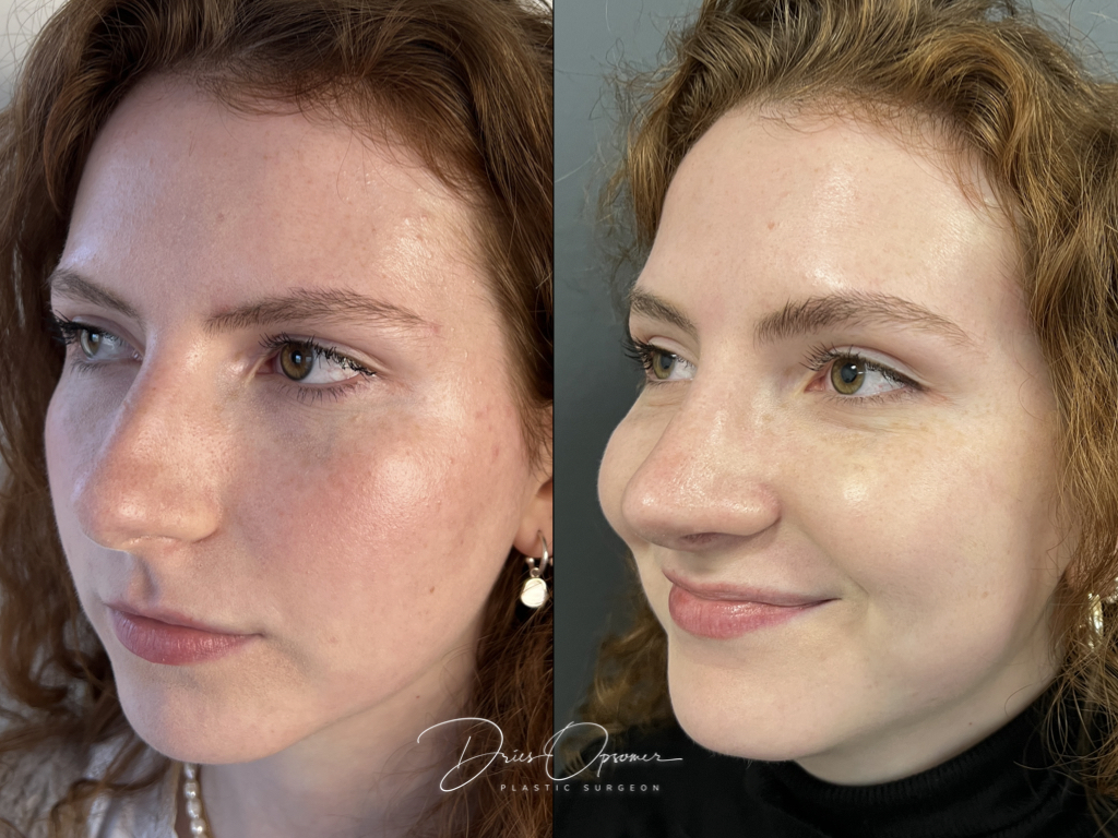 rhinoplastie-dries-opsomer-17