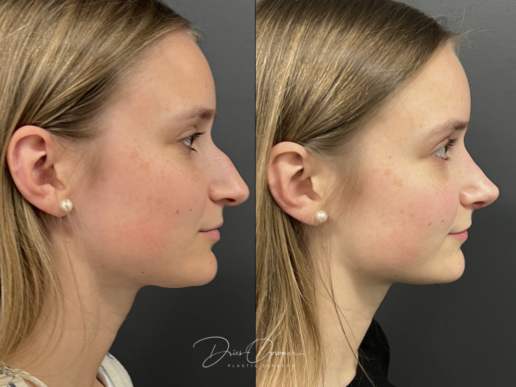 rhinoplastie-dries-opsomer-2