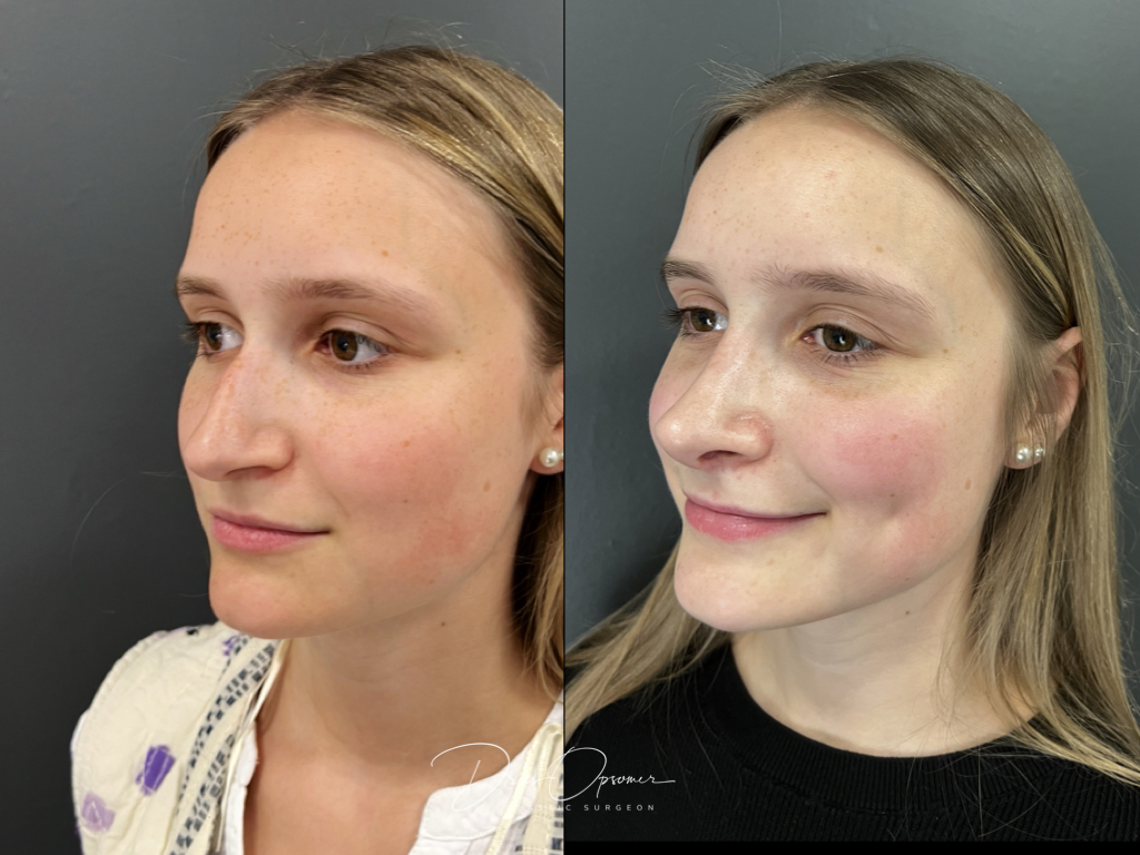 rhinoplastie-dries-opsomer-4