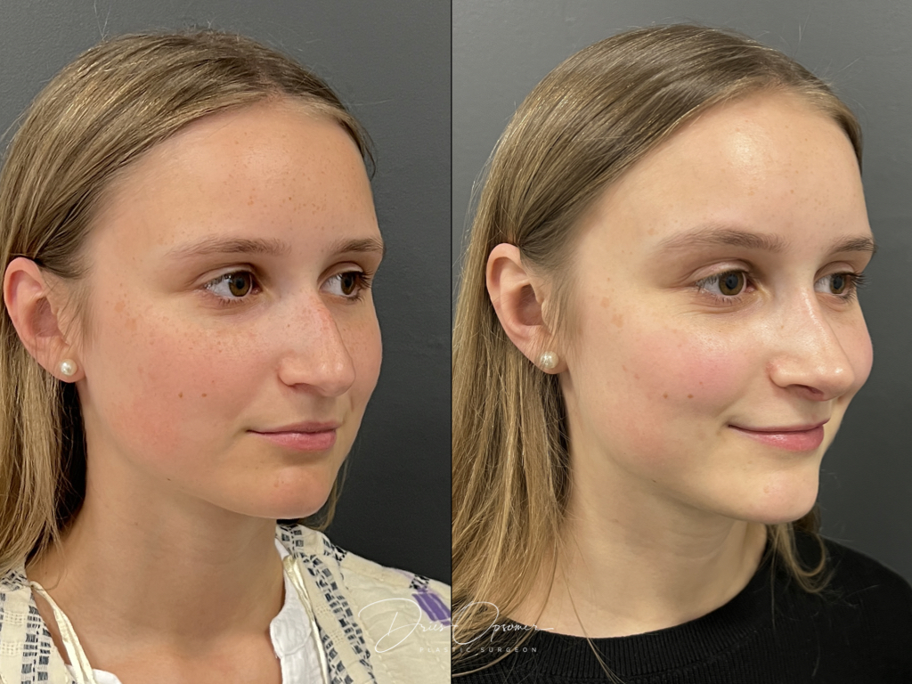 rhinoplastie-dries-opsomer-5