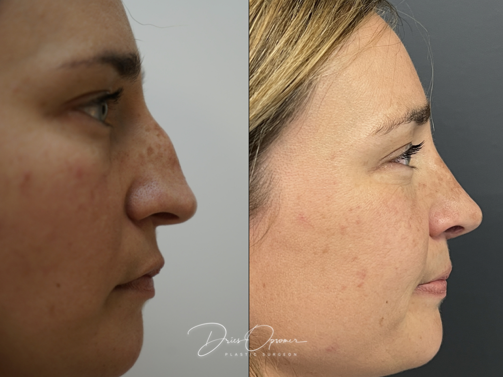 rhinoplastie-dries-opsomer-7
