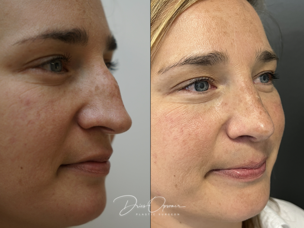 rhinoplastie-dries-opsomer-8