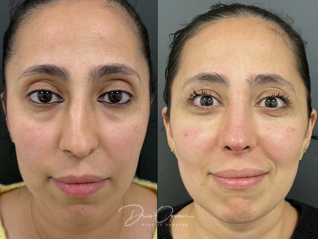 rhinoplastie-dries-opsomer-9